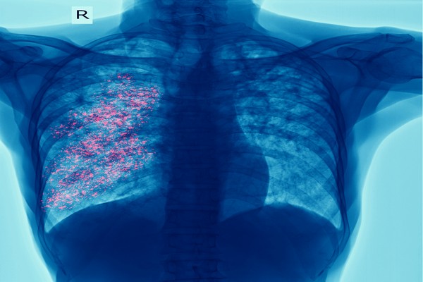 El cáncer de pulmón sigue siendo la principal causa de muerte por cáncer: la detección temprana es clave para cambiar esta realidad