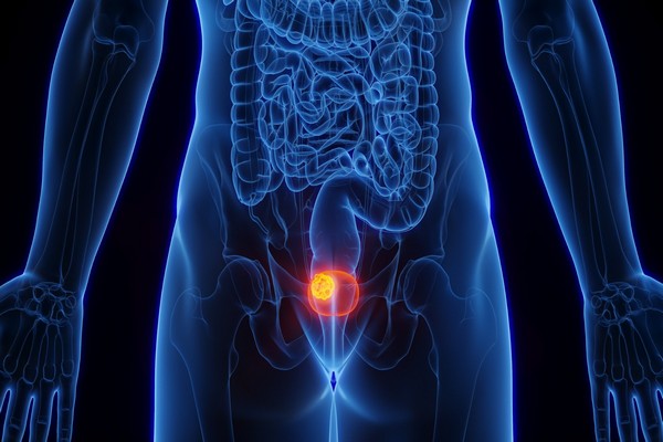 MFINZI® de AstraZeneca reduce riesgo de recaída y mejora supervivencia en pacientes con cáncer de vejiga músculo invasivo